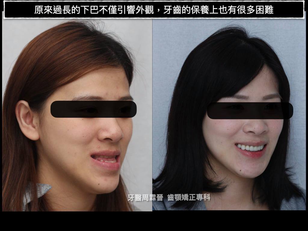 戽斗矯正 - 外型前後對比照.jpg