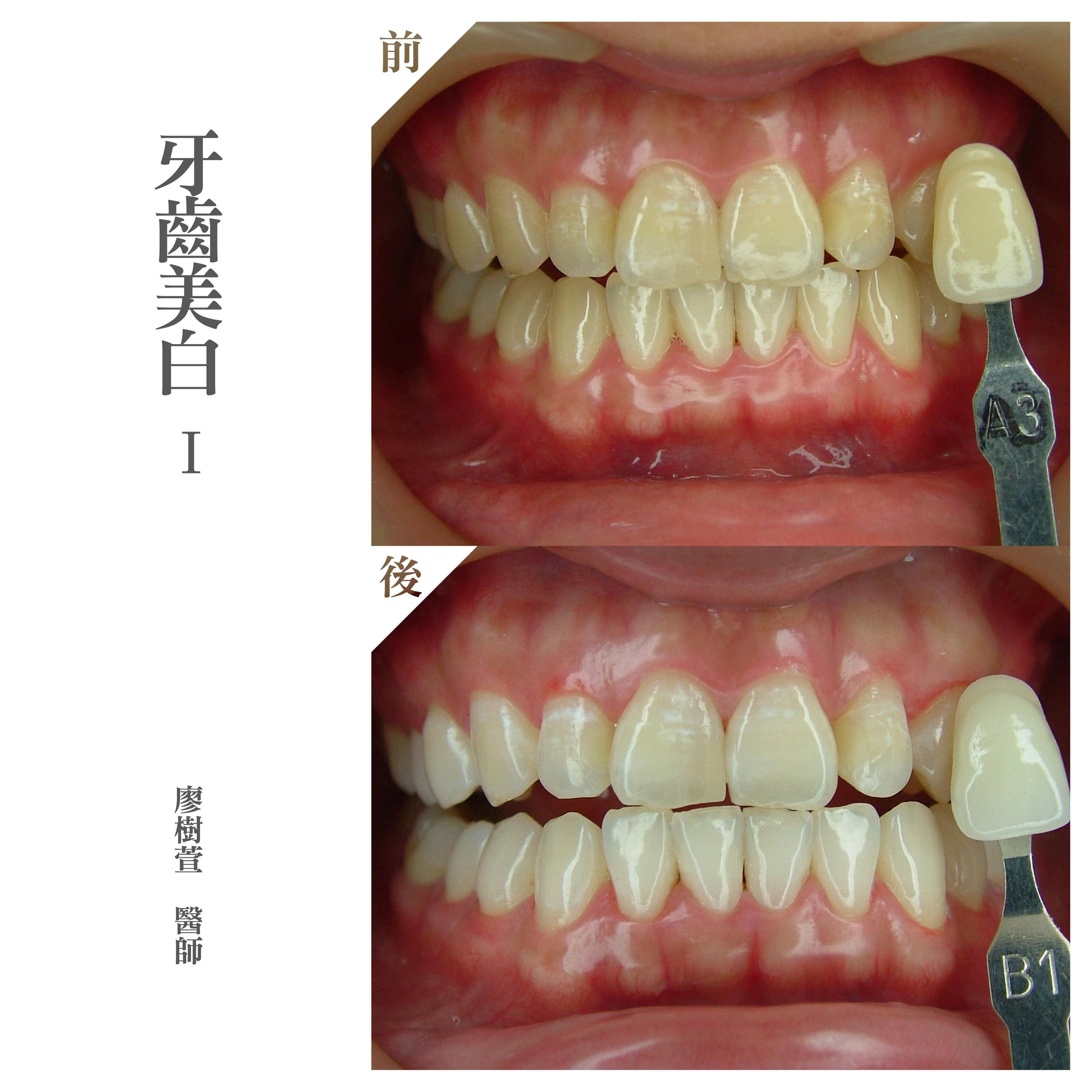 牙齒美白推薦 - 廖樹萱醫師 .jpg
