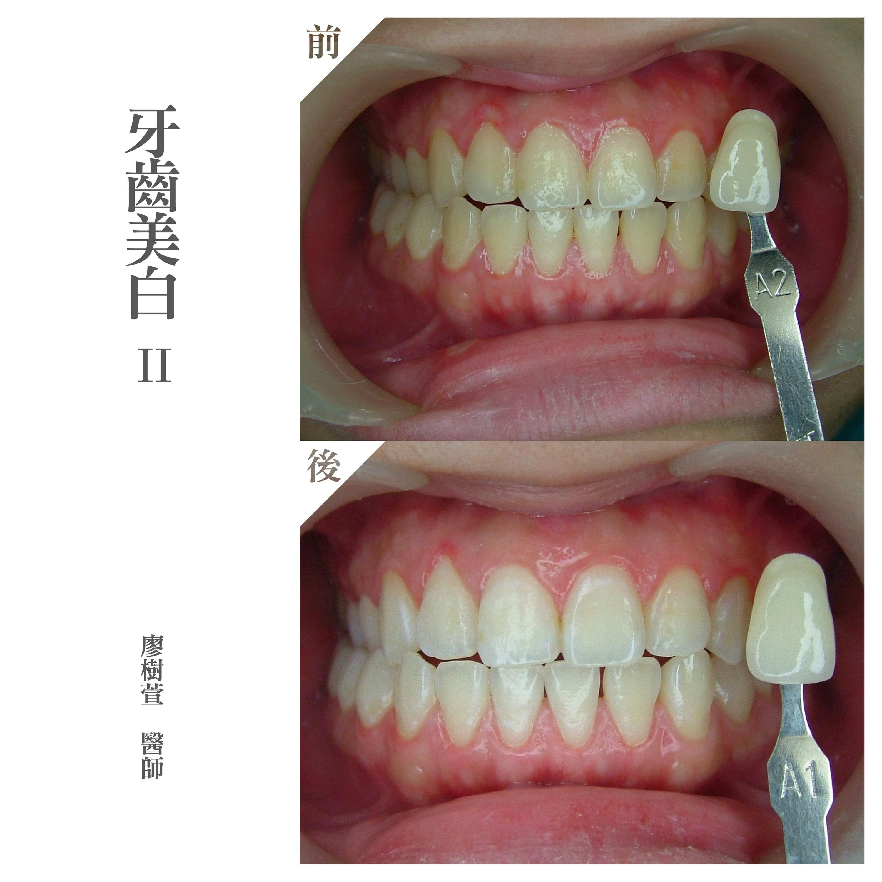 牙齒美白推薦-廖樹萱醫師.jpg