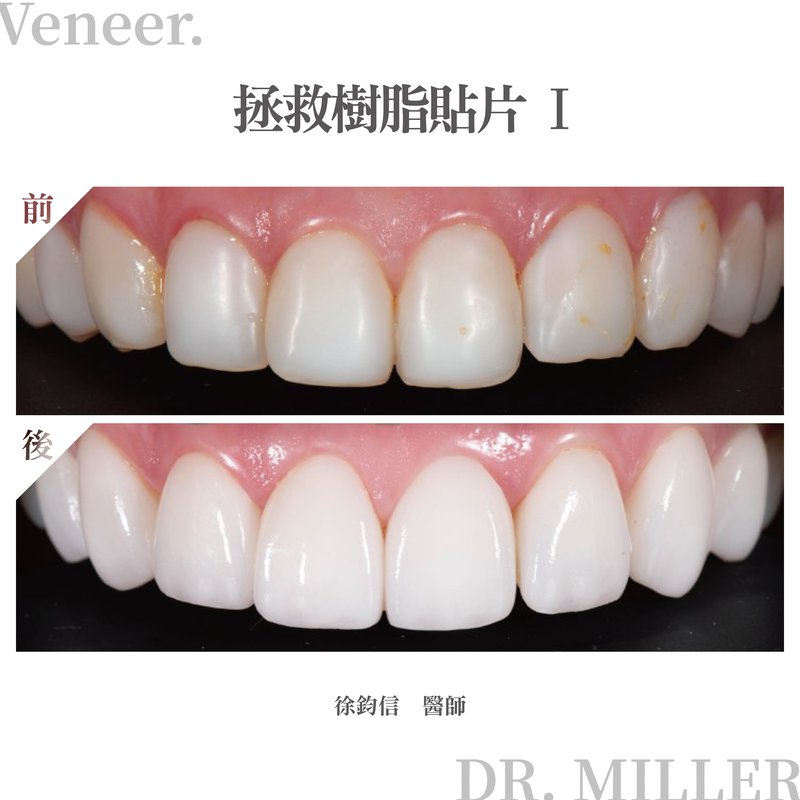 拯救樹脂貼片 1.jpg