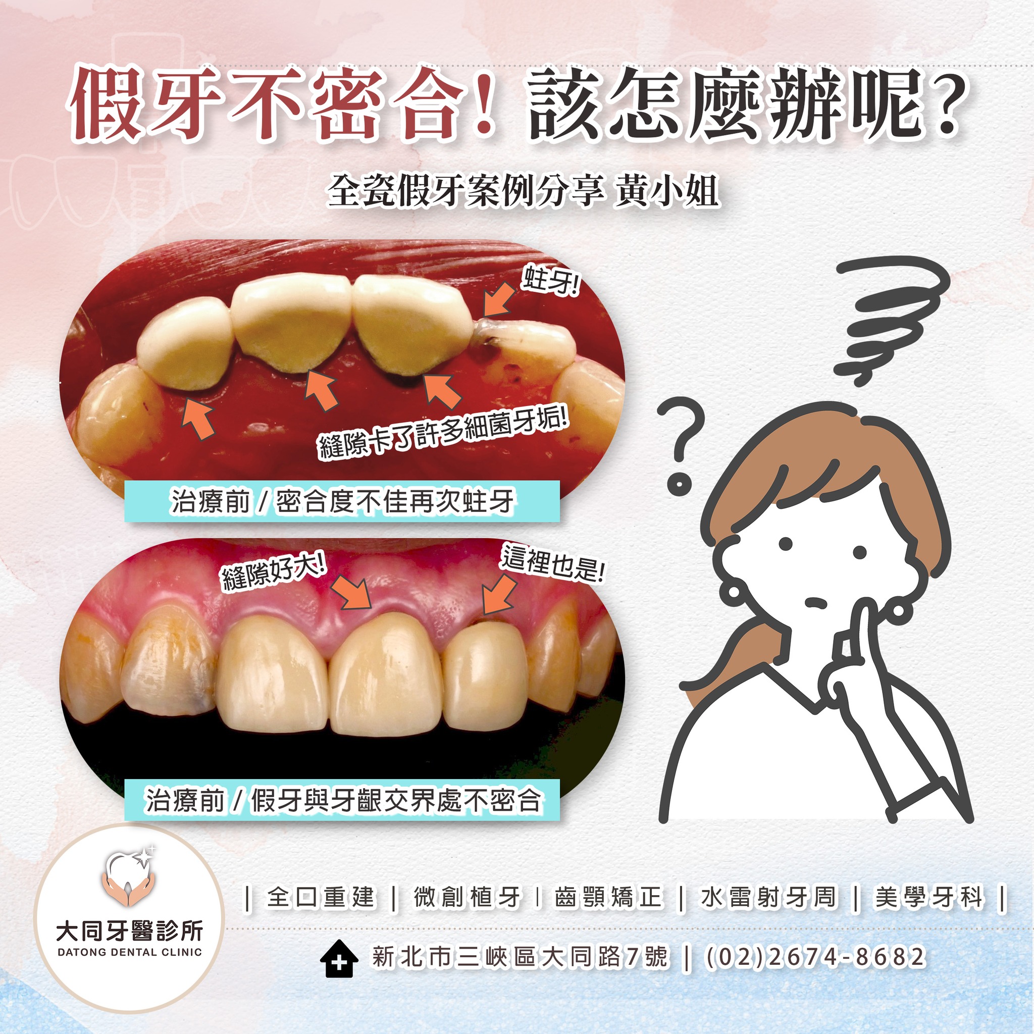 您的假牙該換了嗎？