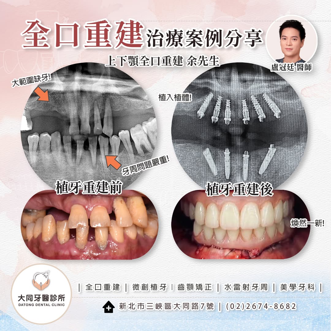 全口重建案例分享