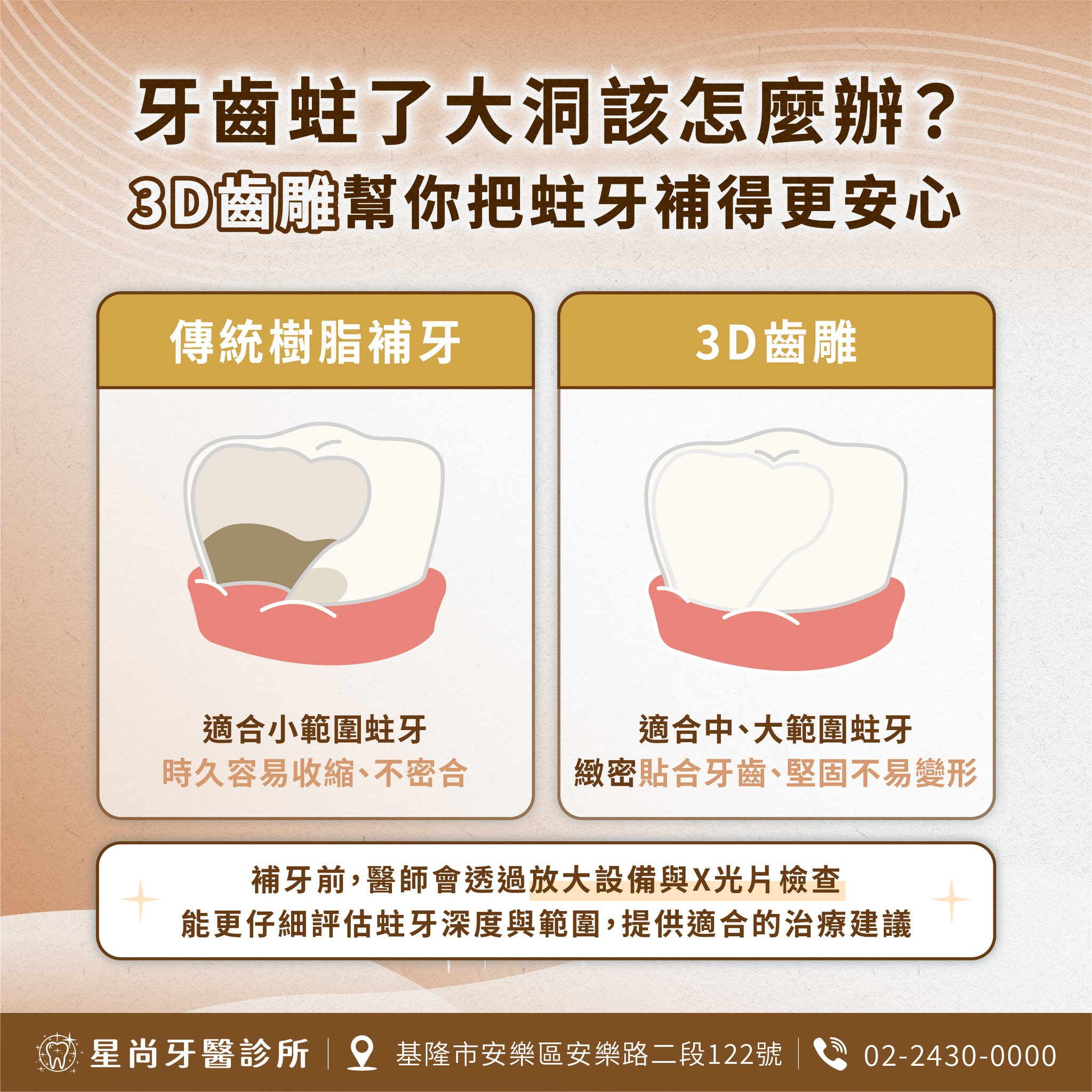 補過的牙齒，還是有可能從小洞悄悄變成「深坑」？🦷