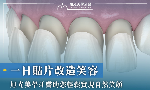 一日貼片改造笑容，旭光美學牙醫助您輕鬆實現自然笑顏