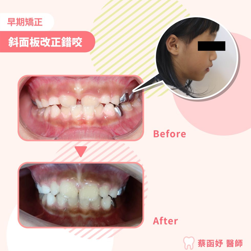 斜面板改正錯咬