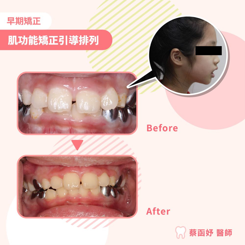 肌功能矯正引導排列