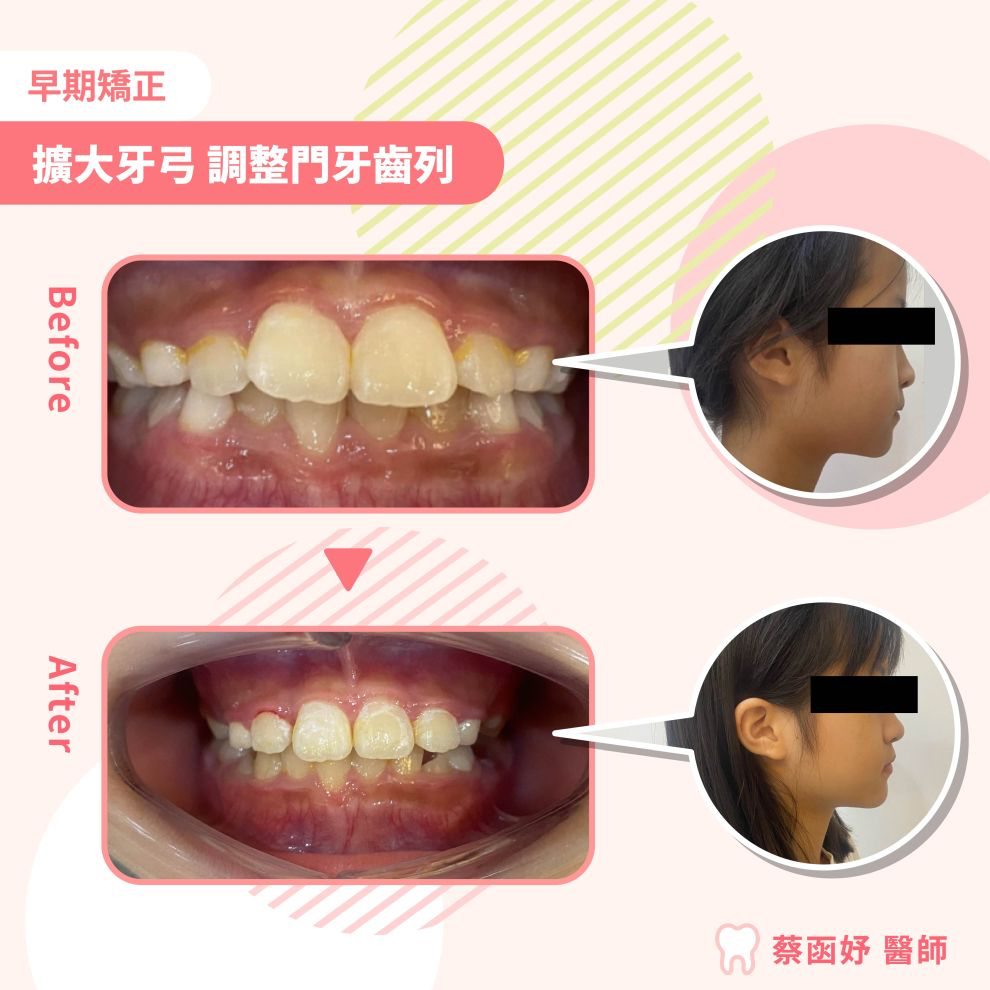 擴大牙弓調整門牙排列