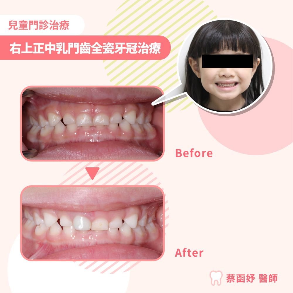 兒童全瓷牙冠