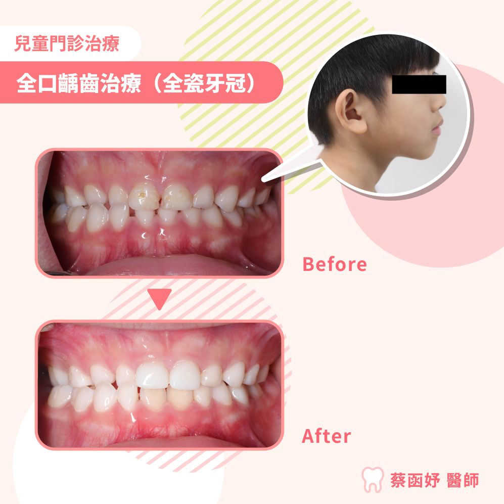 兒童全瓷牙冠