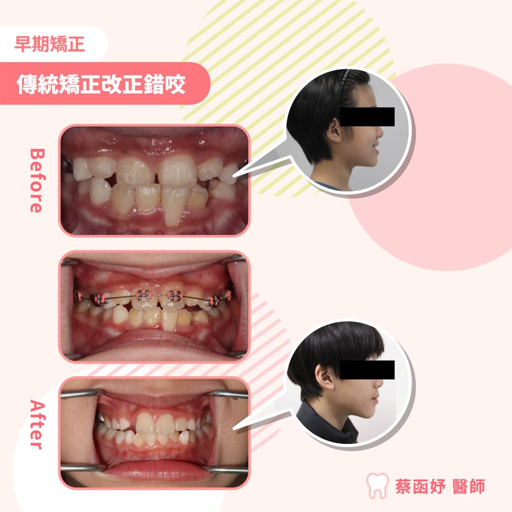 傳統矯正改正錯咬