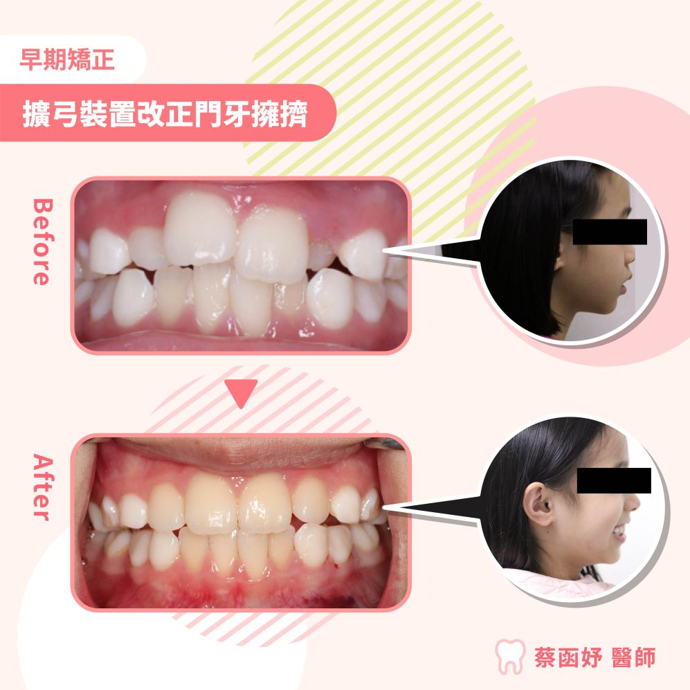 擴大牙弓改正門牙排列