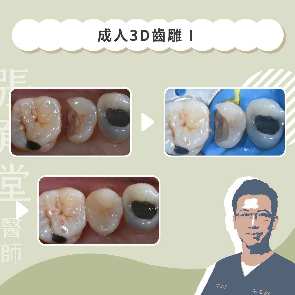 成人3D齒雕