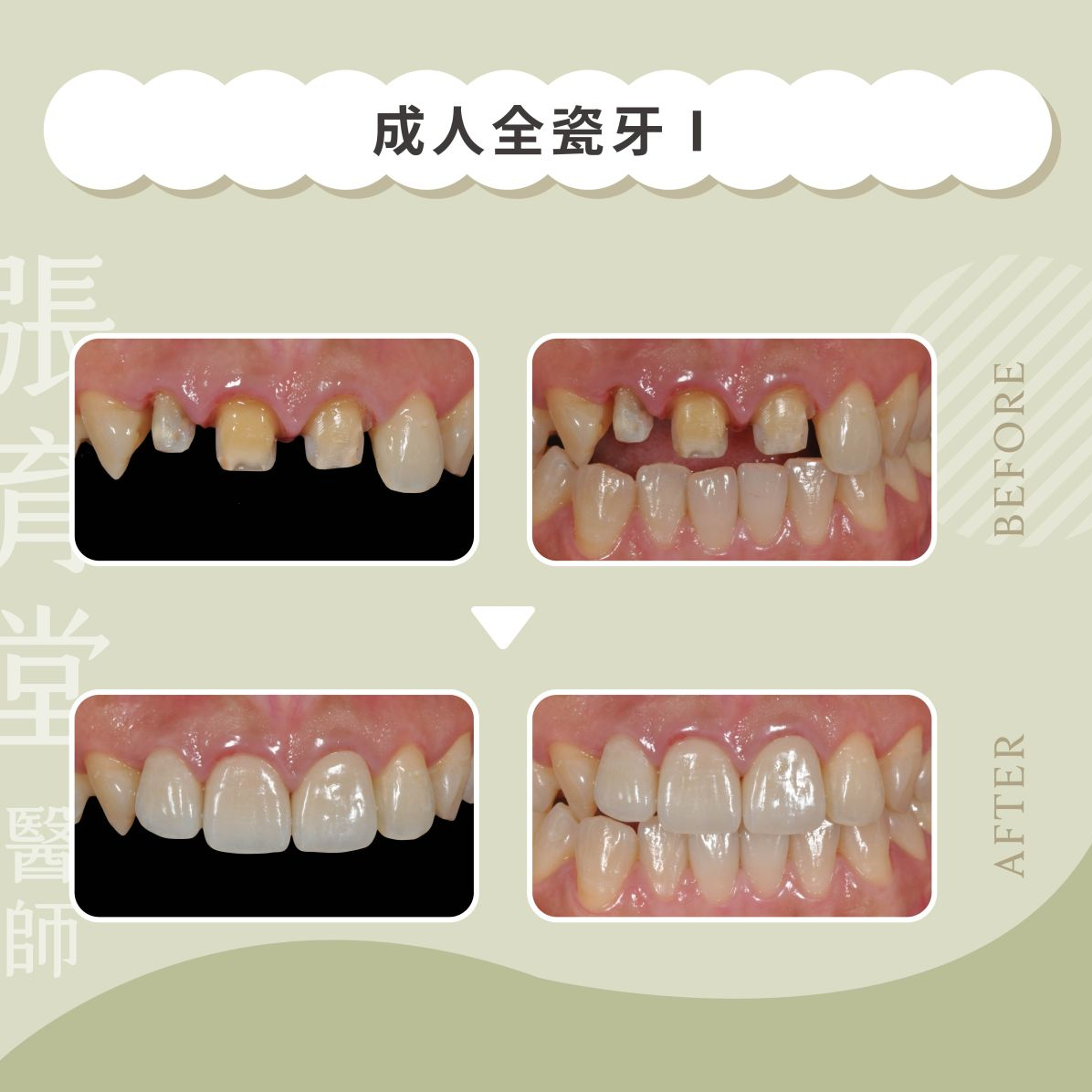 成人全瓷牙