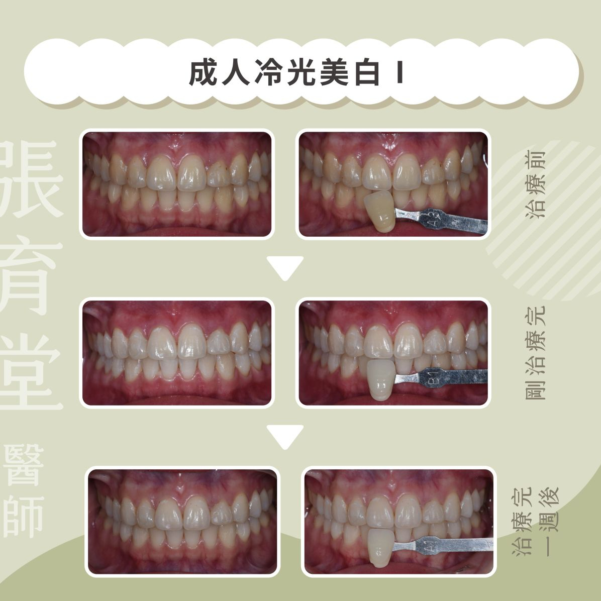 成人冷光美白