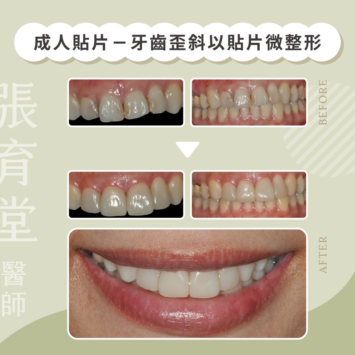 成人貼片