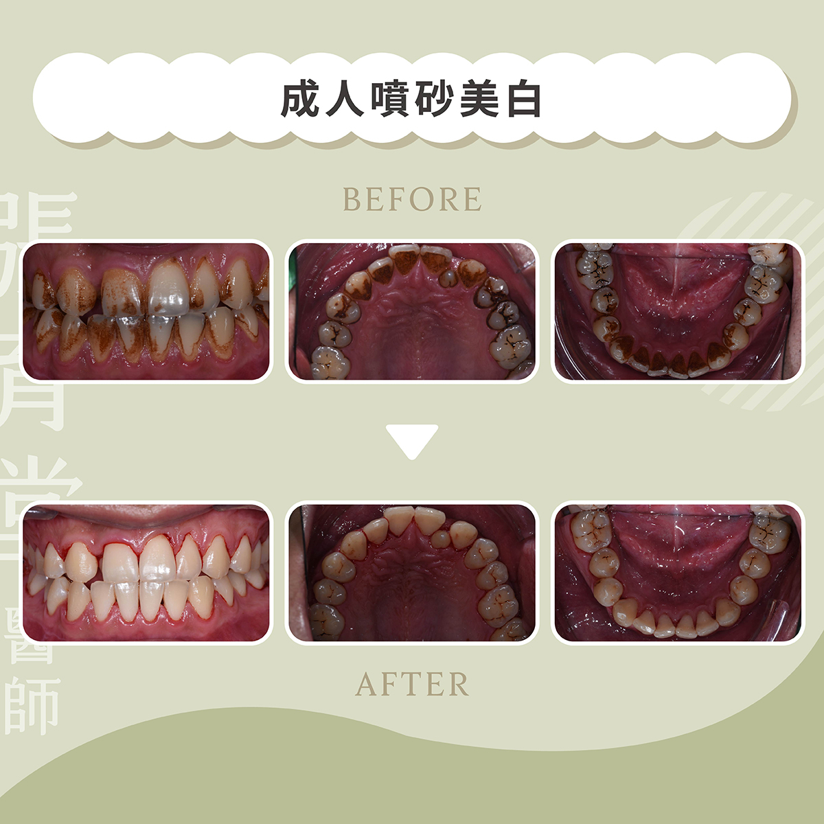 成人噴砂美白