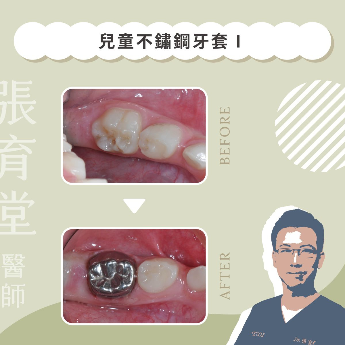 兒童不鏽鋼牙套