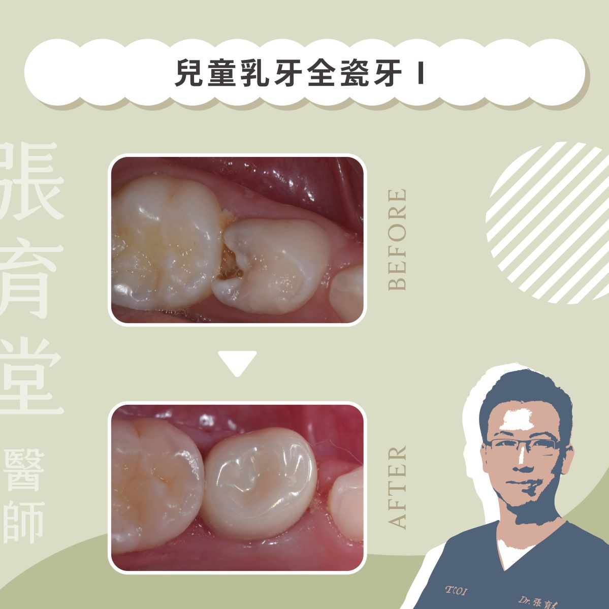 兒童乳牙全瓷牙