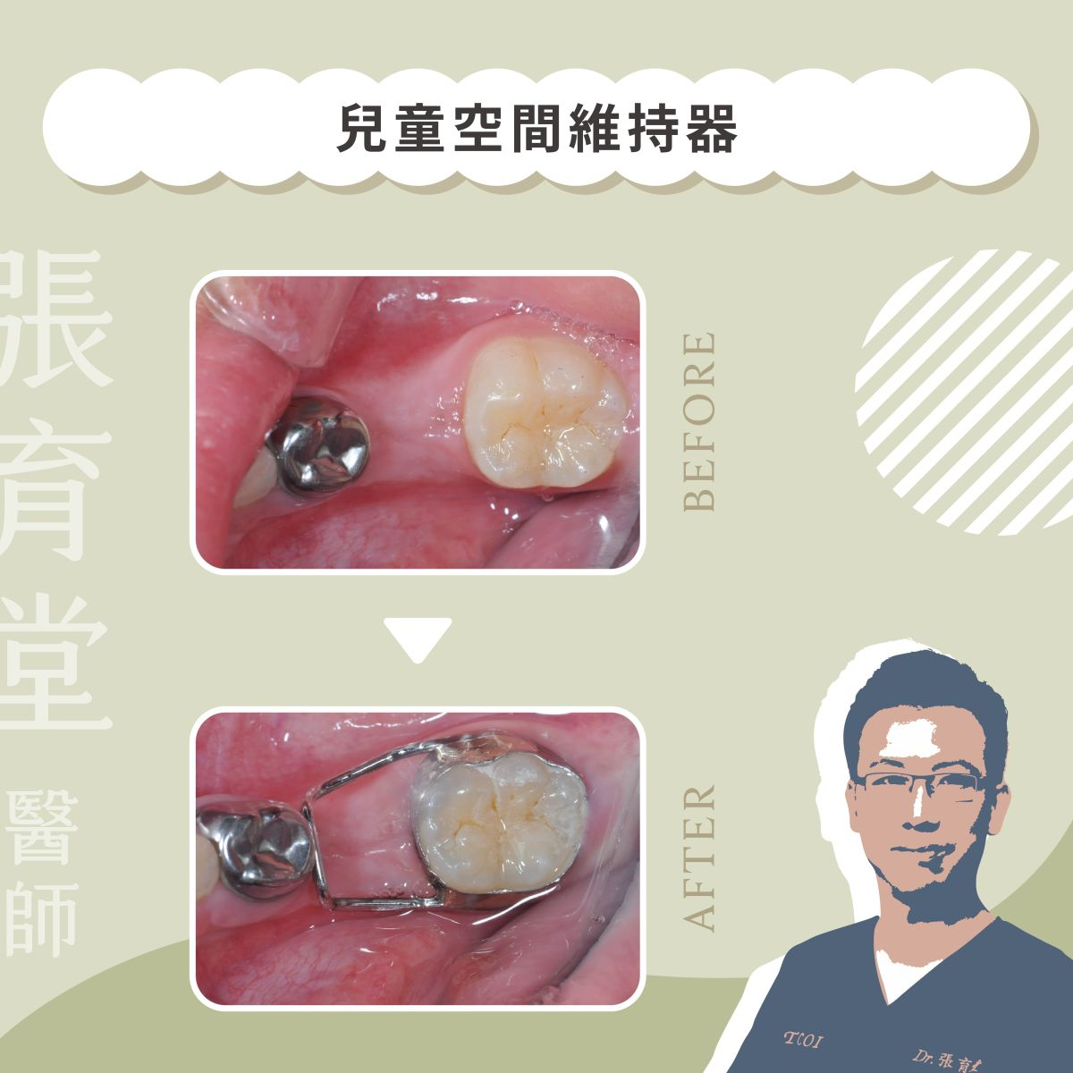 兒童空間維持器