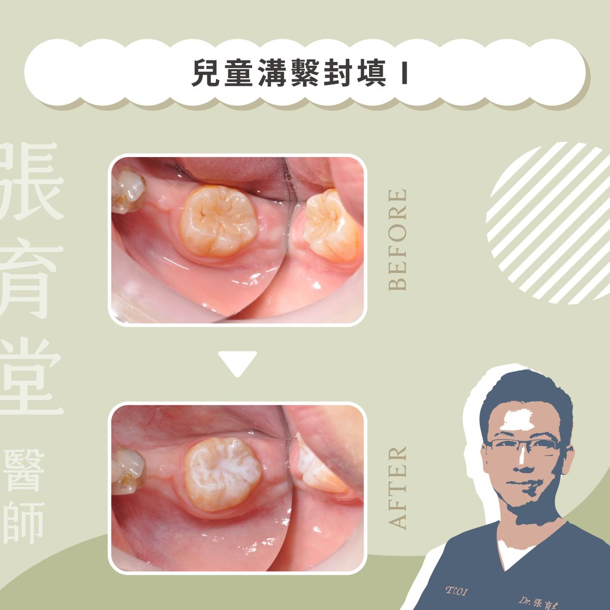 兒童溝繫封填