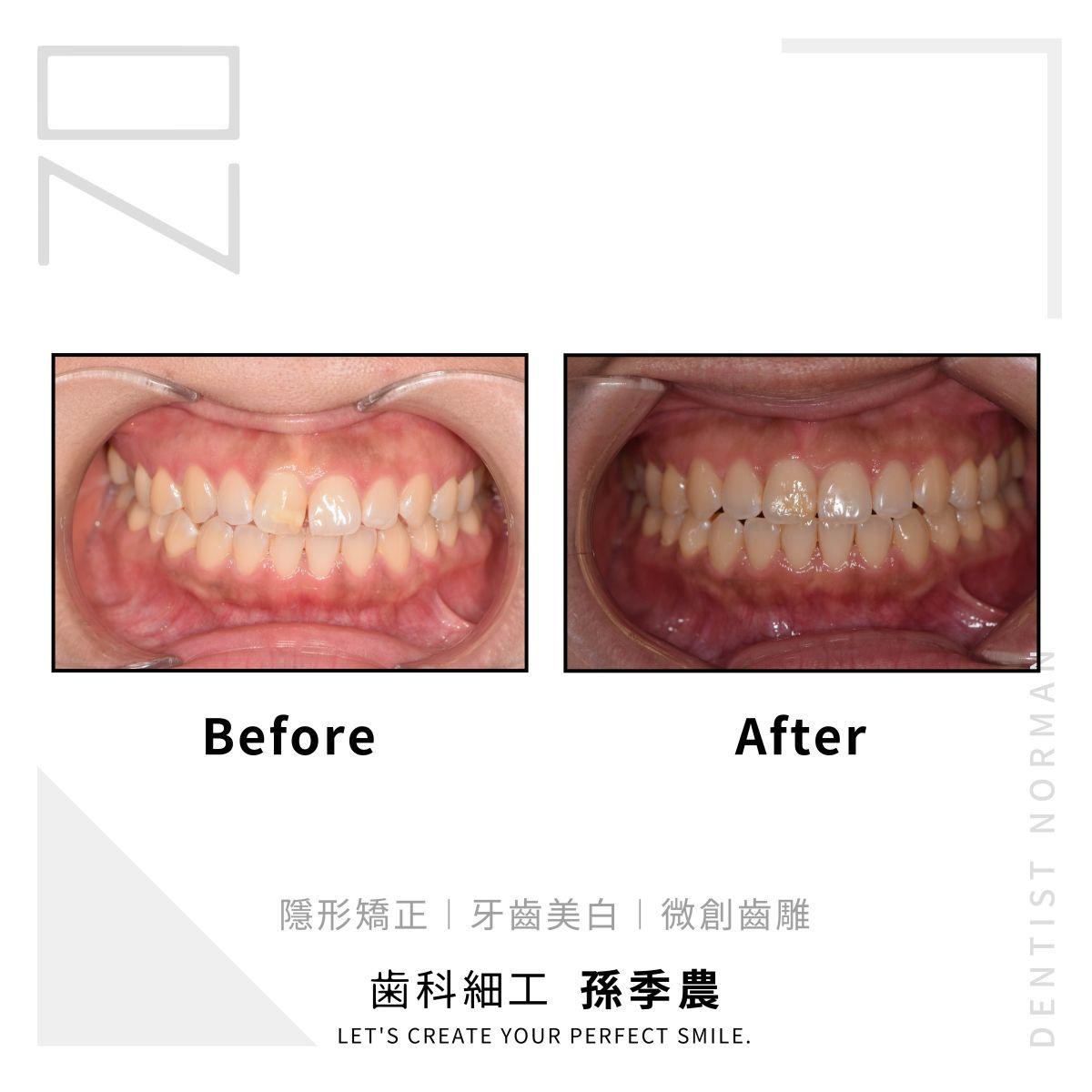 隱形矯正