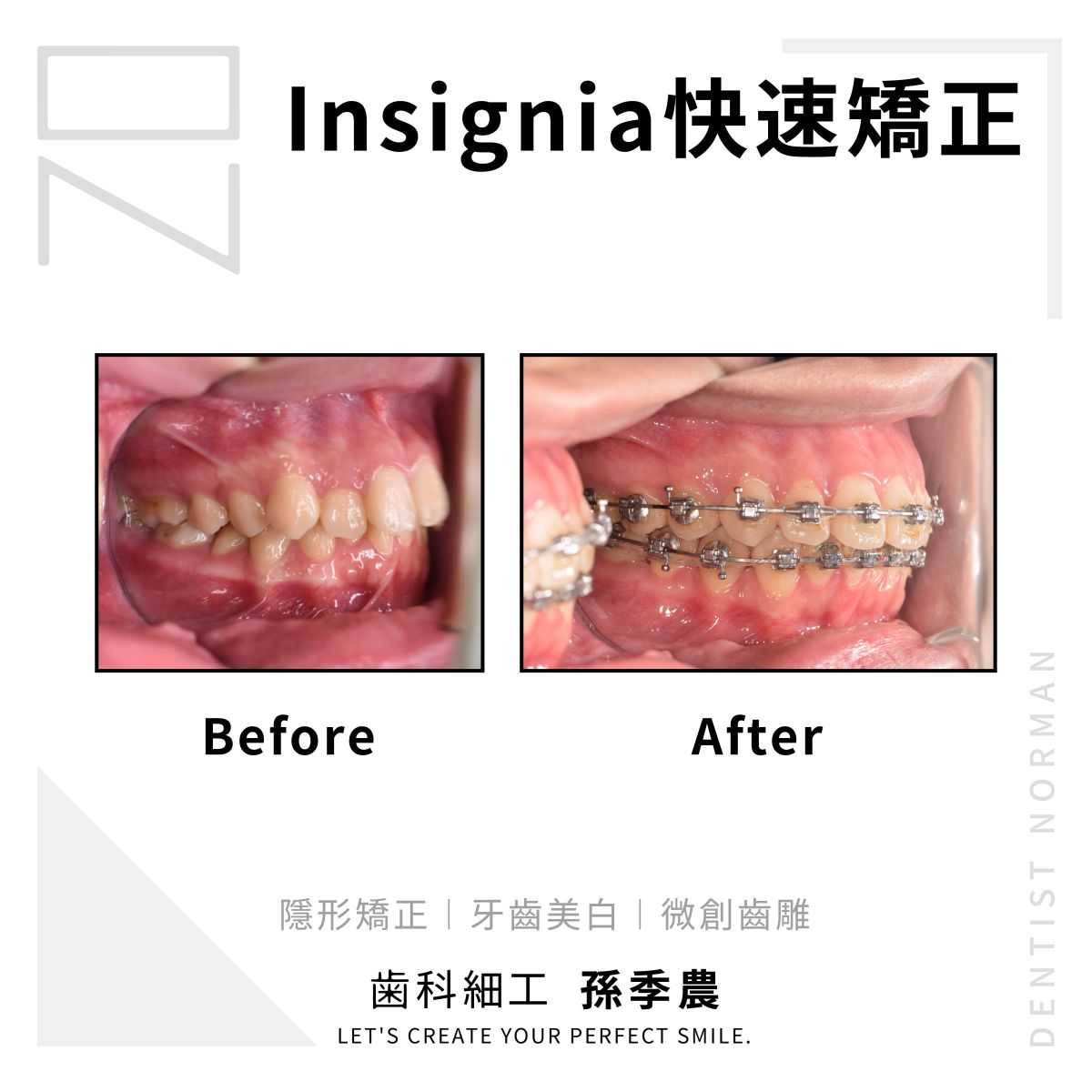 Insignia 快速矯正