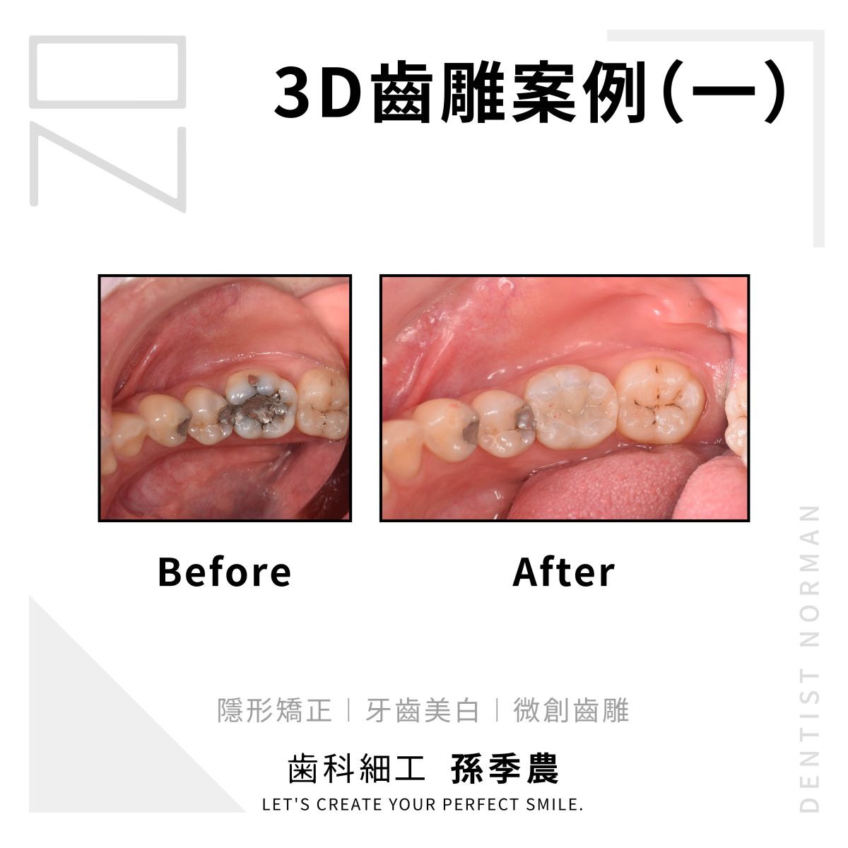 3D齒雕案例(一)