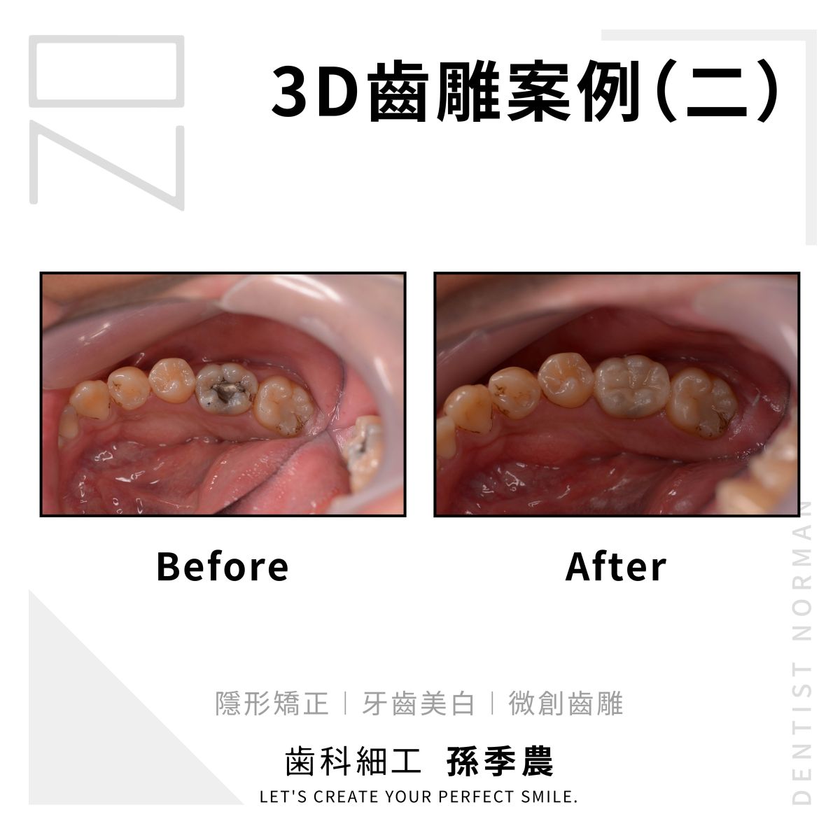 3D齒雕案例(二)