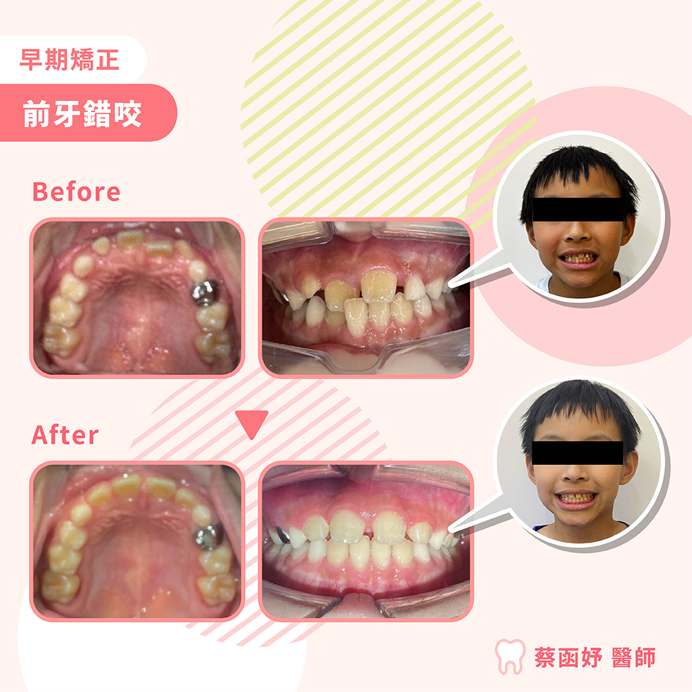 前牙錯咬