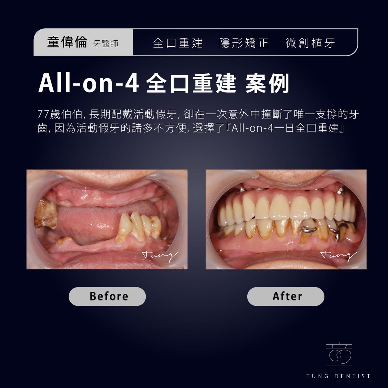 All-on-4全口重建案例分享✨鄭伯伯 - 77 歲