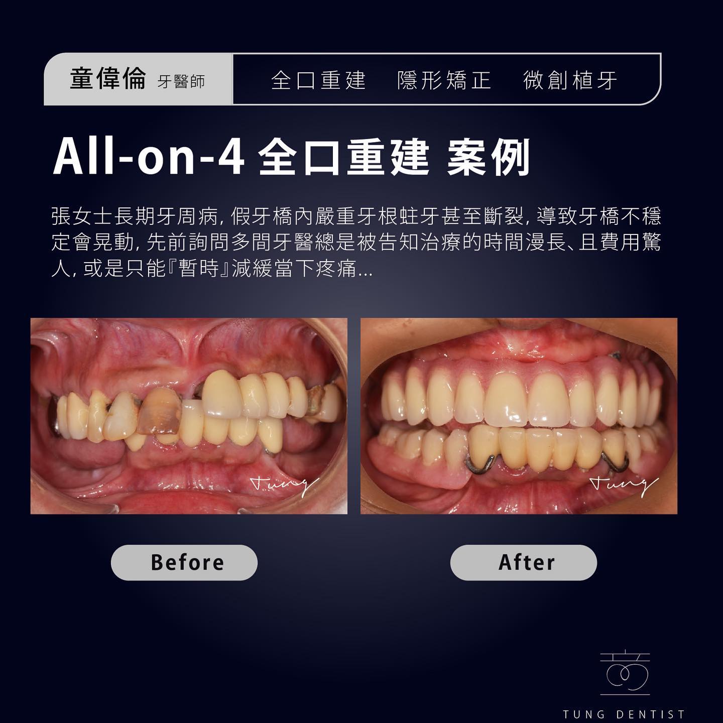 All-on-4 全口重建案例分享✨張女士