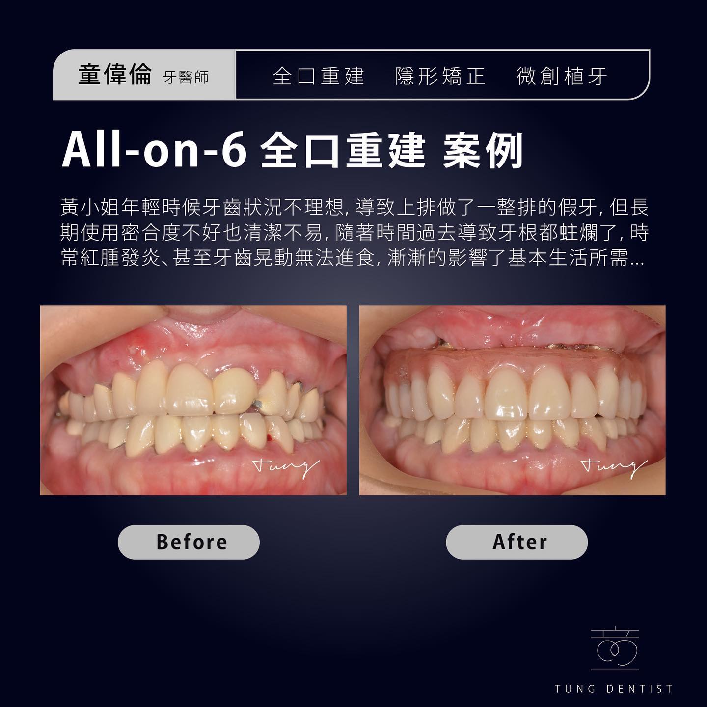 All-on-6 全口重建案例分享✨黃小姐