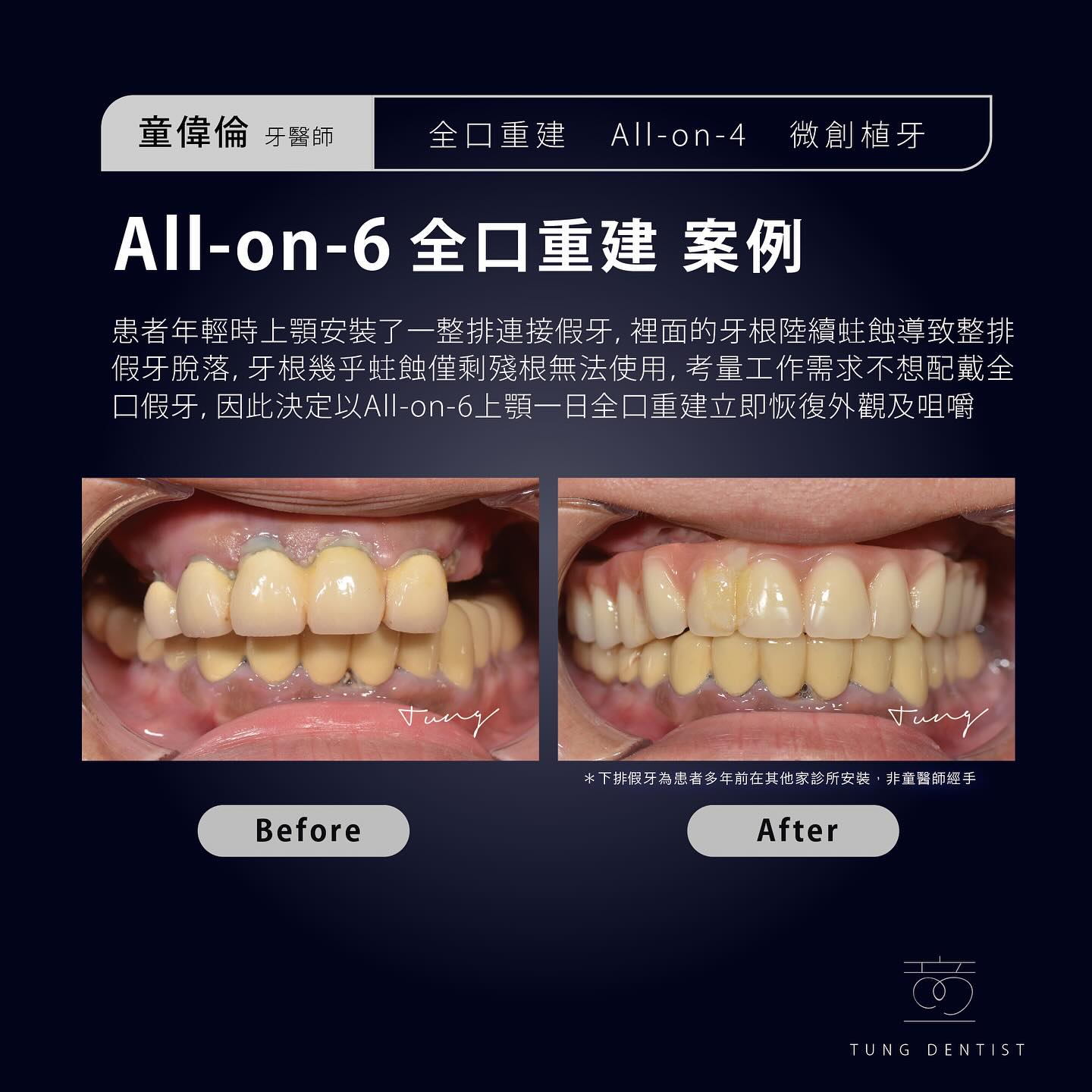 All-on-6 全口重建案例