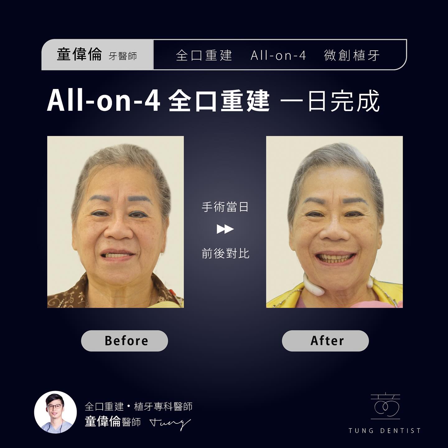 倪女士 All on 4 一日全口重建故事分享