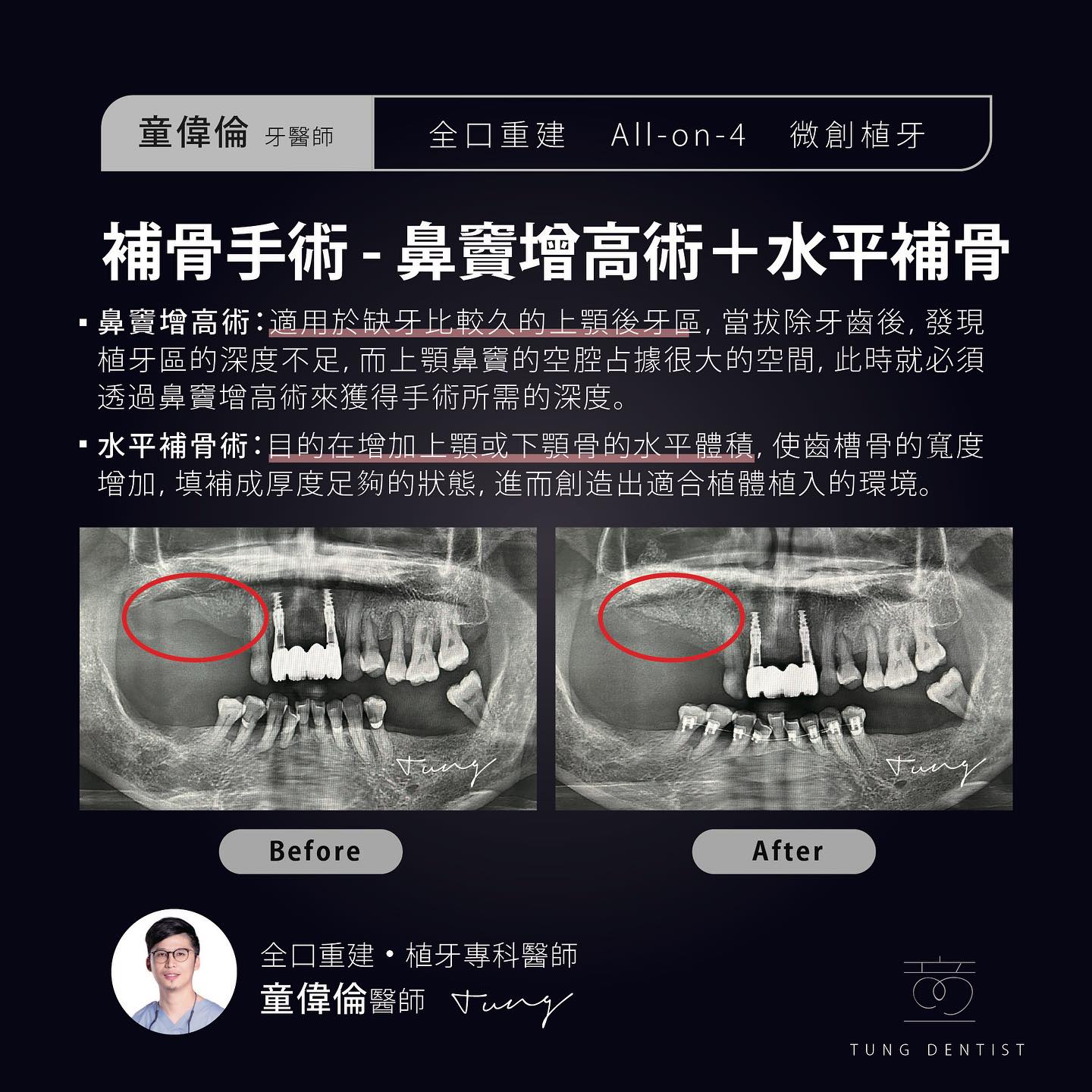 困難補骨案例分享