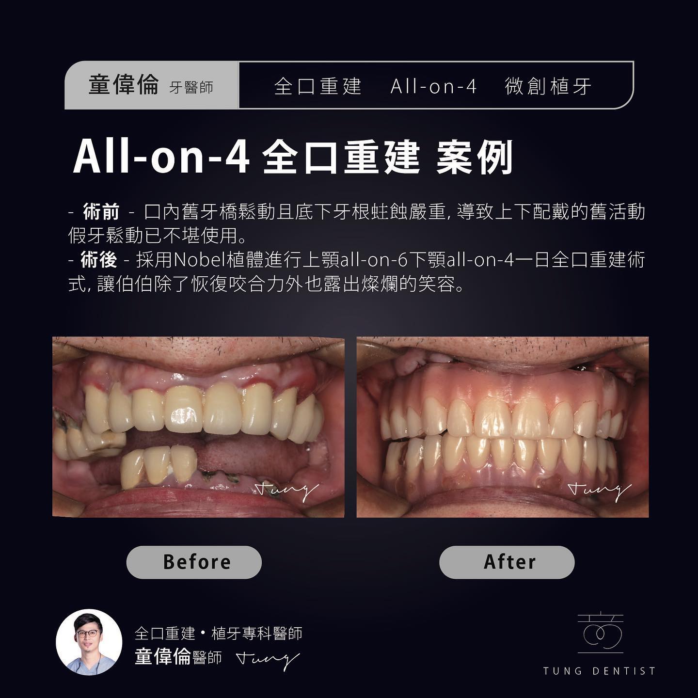 陳伯伯上顎 all on 6 下顎 all on 4 一日全口重建案例分享