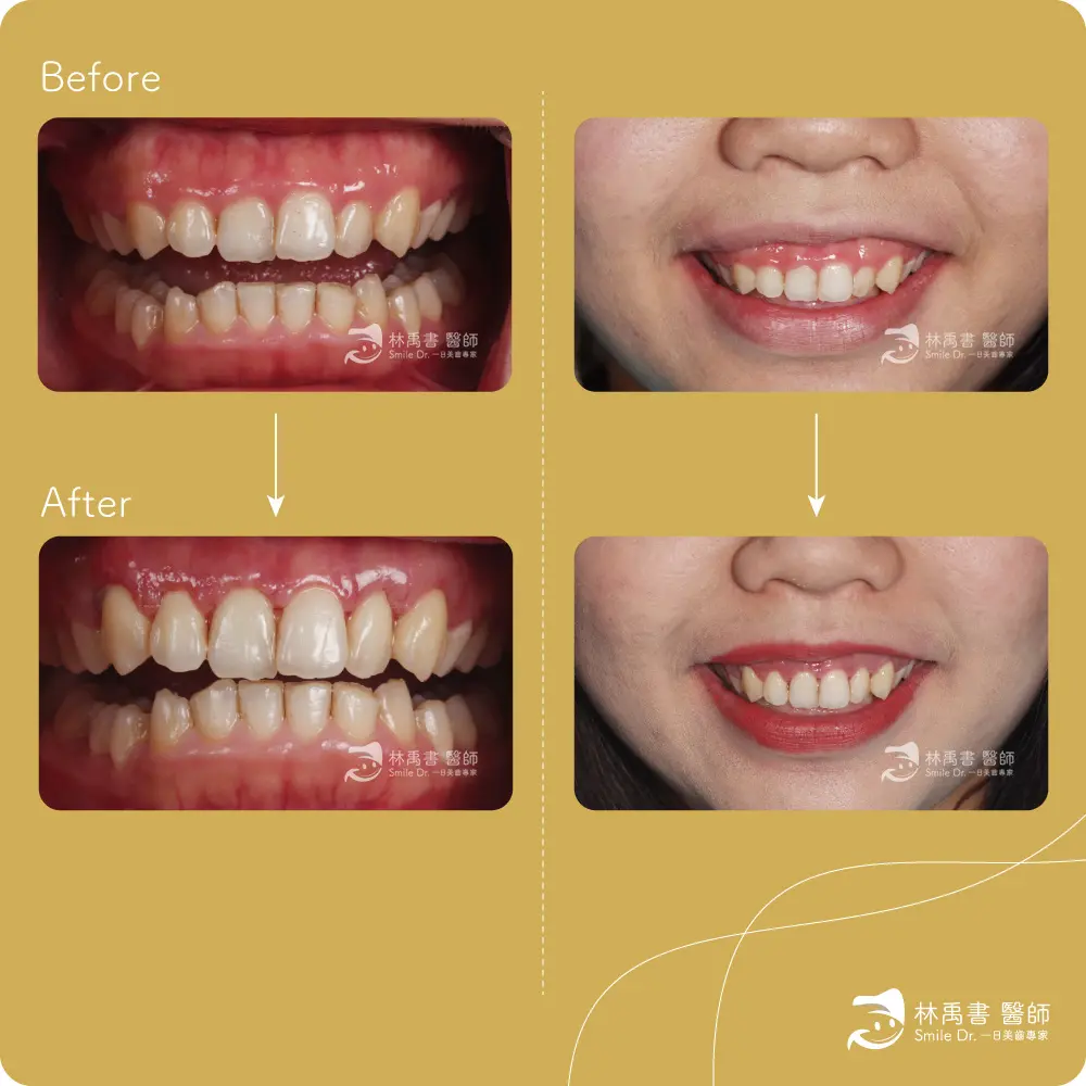 水雷射牙周美學案例1
