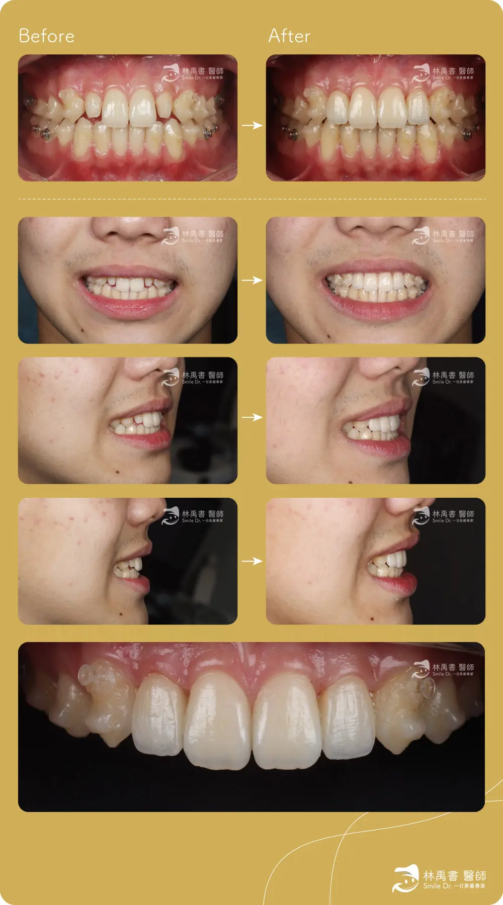 前牙貼片-兩顆貼片