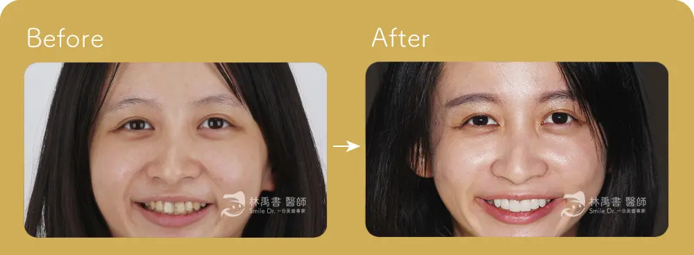 前牙貼片-黃小姐