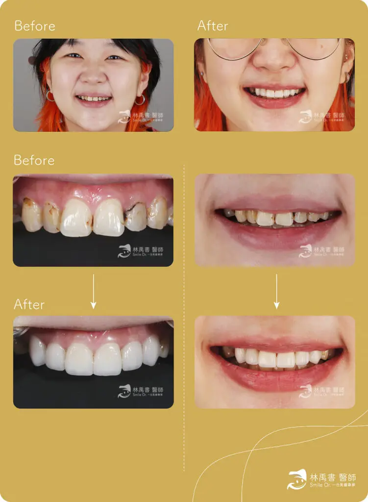 前牙貼片-黃小姐