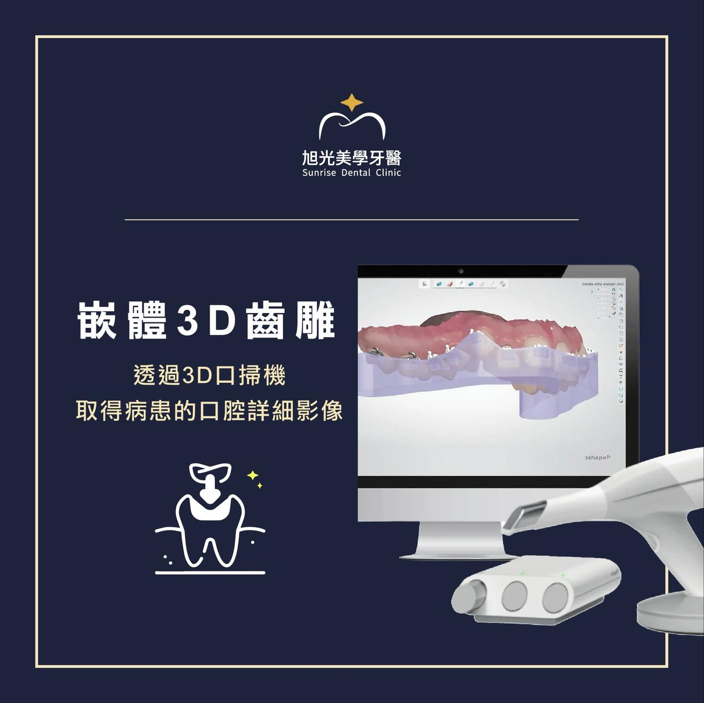 嵌體 3D 齒雕