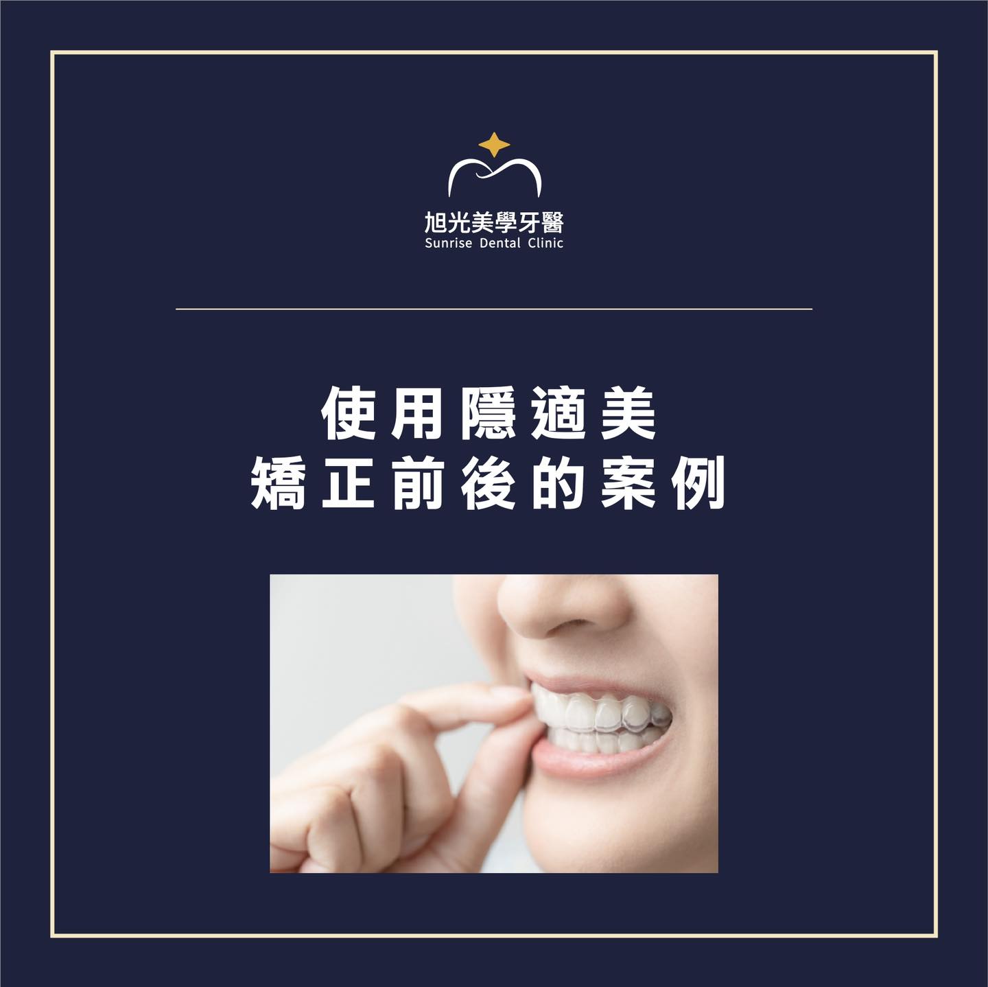 使用隱適美矯正前的案例