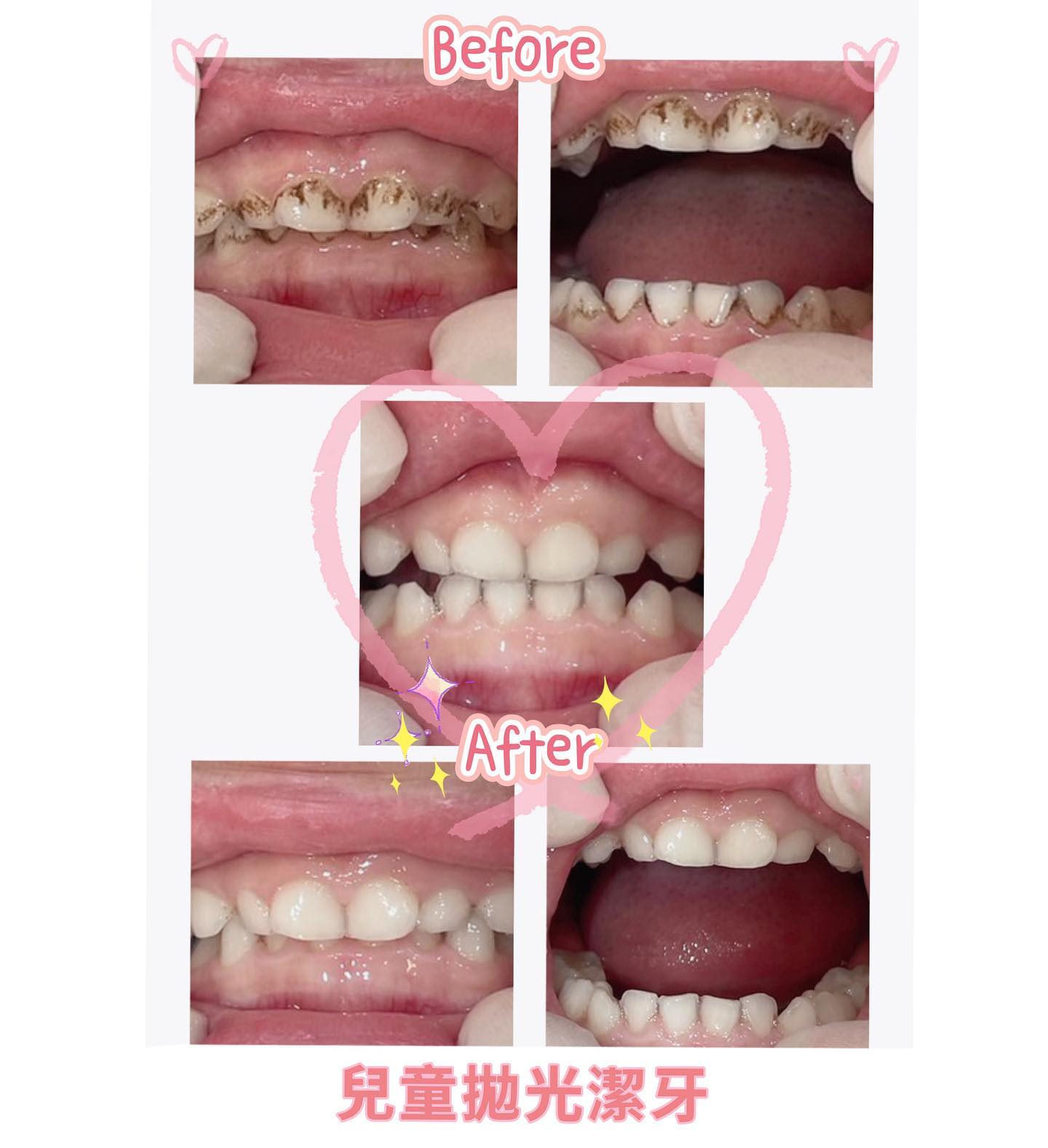 牙齒美白案例