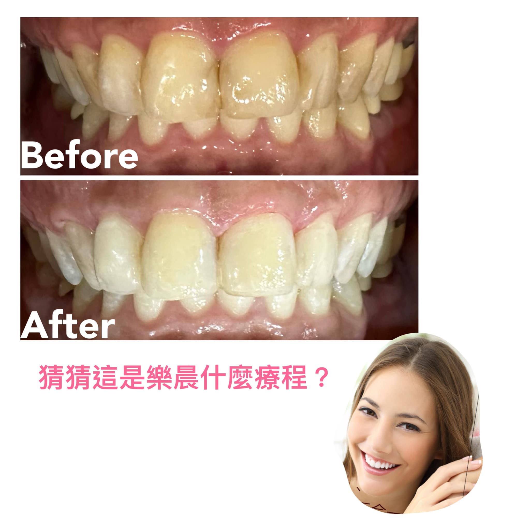 牙齒美白案例