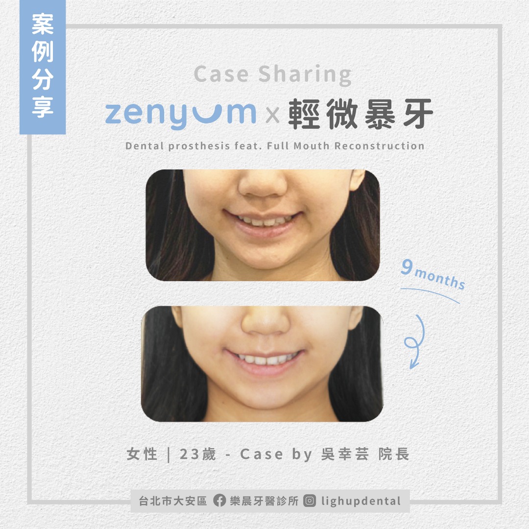Zenyum隱形矯正案例