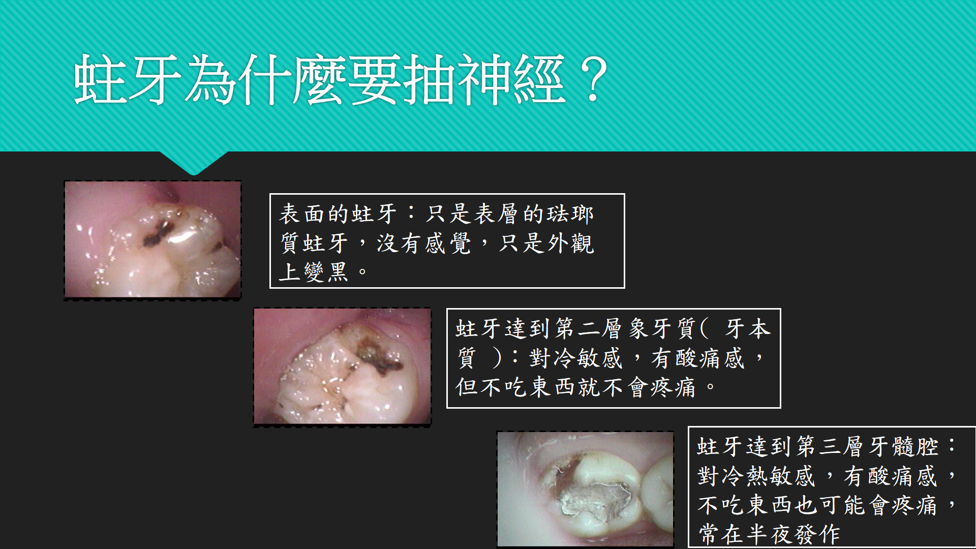 蛀牙為什麼要抽神經？什麼是根管治療？