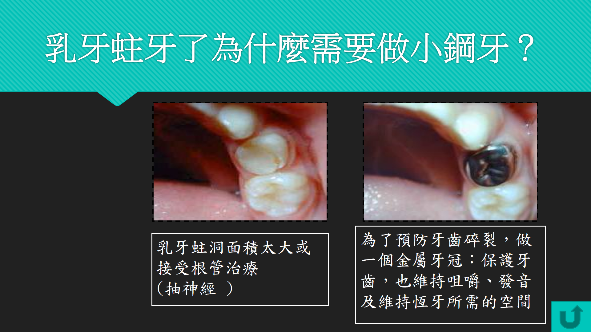乳牙蛀牙了為什麼需要做小鋼牙？