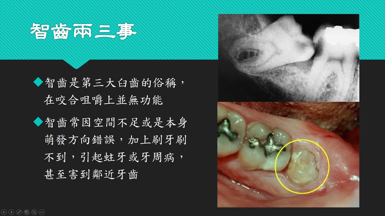 智齒一定要拔嗎？