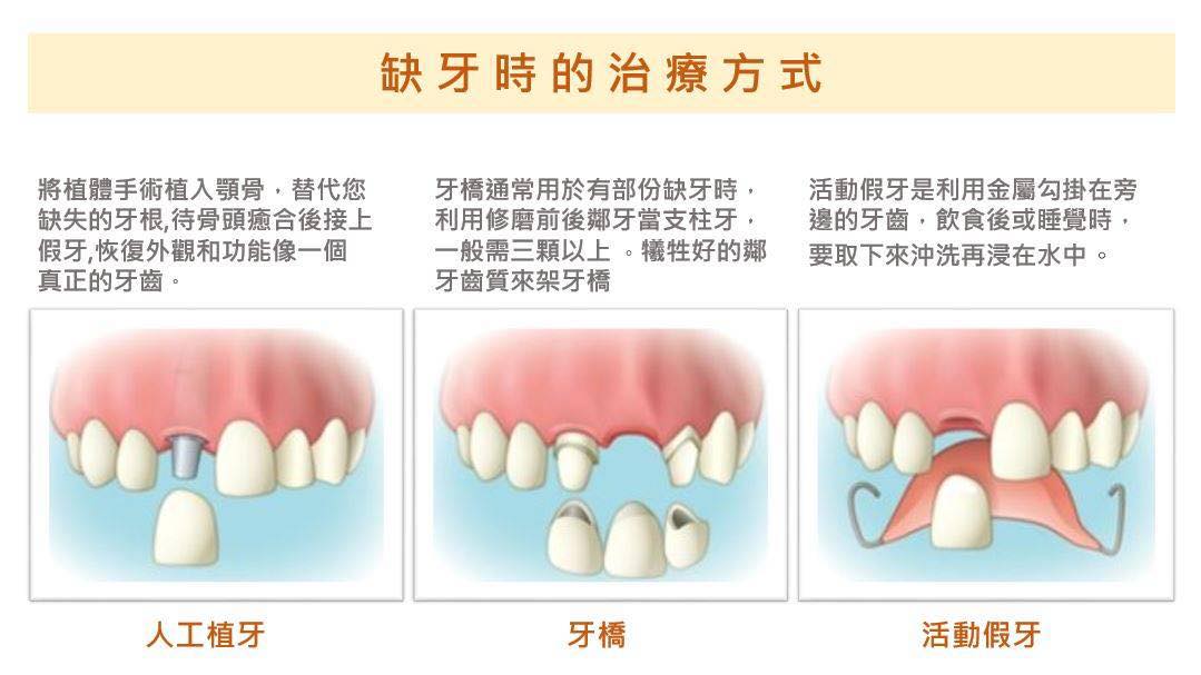 你知道長期缺牙會帶來什麼影響嗎?