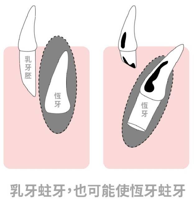 乳牙蛀掉沒關係❓